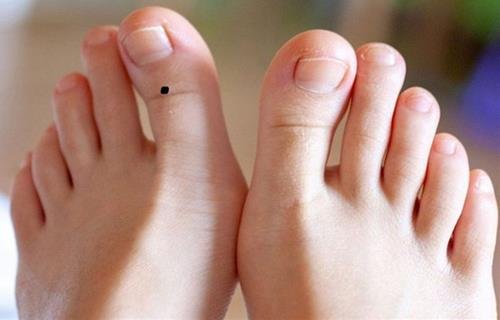 Nốt ruồi ở ngón chân cái